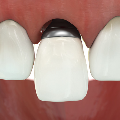 3D printed dental abutments remedy infectious oral diseases