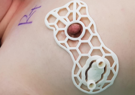 Korean scientists 3D print surgical guides to aid breast tissue retention during cancer surgery