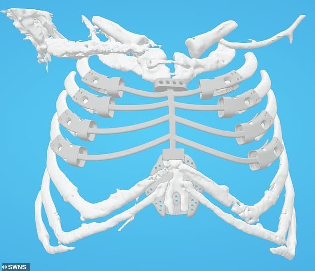 UK patient Becomes Sixth Person in the World Fitted with 3D Printed Rib Cage Implant