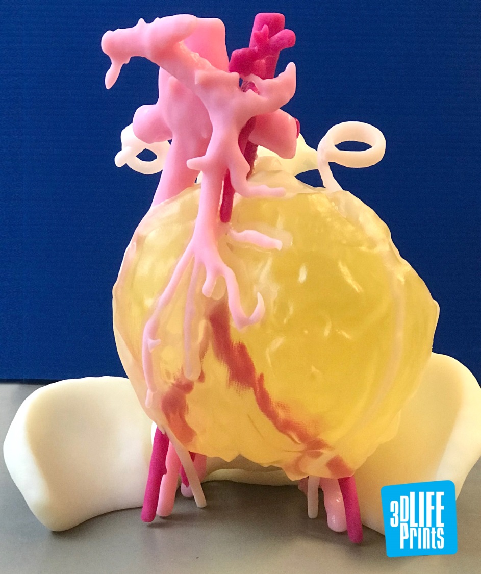 A 3D Printed Tumour Model Leads Cancer Patient to Recovery