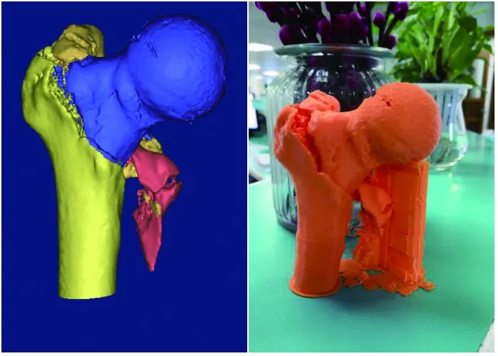 Most Recent Clinical Case Benefited from 3D Printing