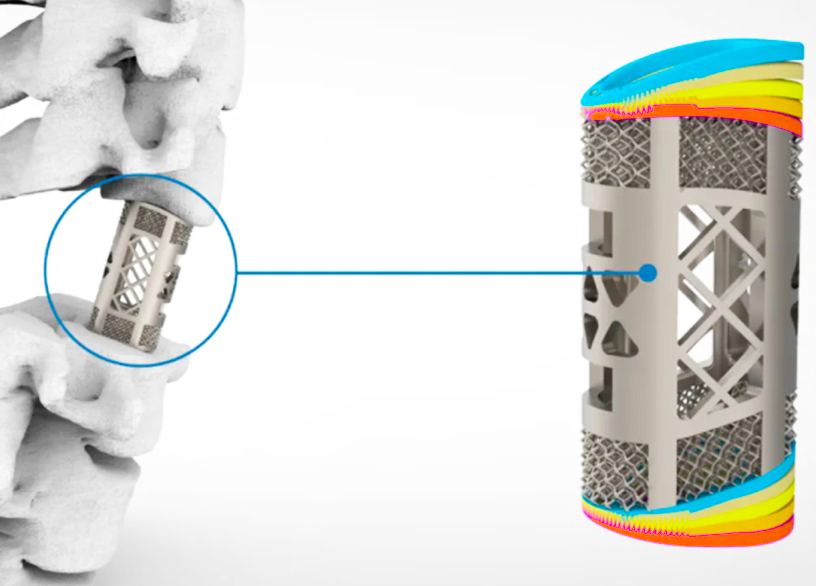 Farsoon 3D Printed Spine Implant Granted “Groundbreaking” NMPA Clearance