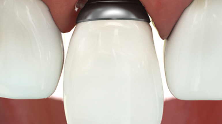 3D printed dental abutments remedy infectious oral diseases