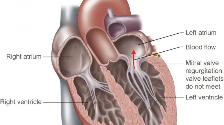 FDA Clears Materialise Mimics Enlight for Catheter-based Cardiovascular Procedures