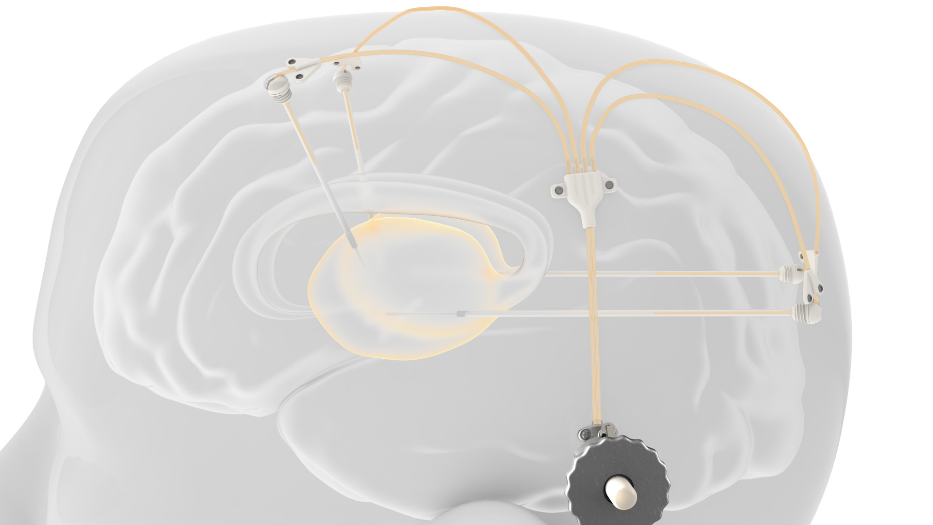 Renishaw Announces Milestone in Parkinson’s Study Using 3D Printed Apparatus