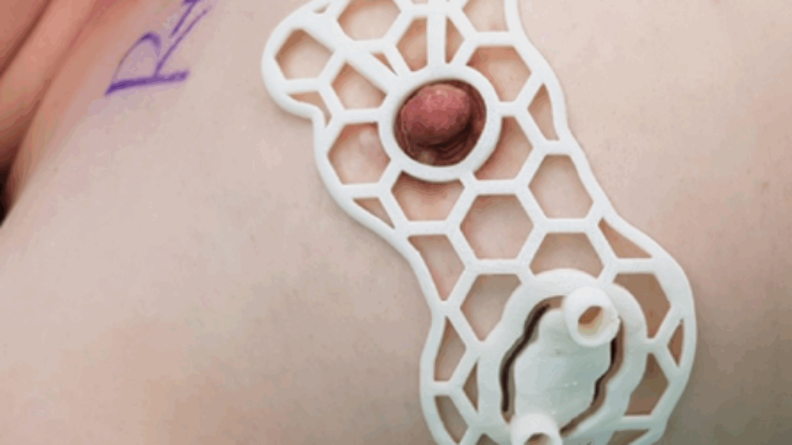 Korean scientists 3D print surgical guides to aid breast tissue retention during cancer surgery