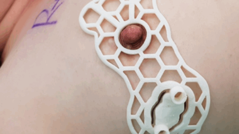 Korean scientists 3D print surgical guides to aid breast tissue retention during cancer surgery