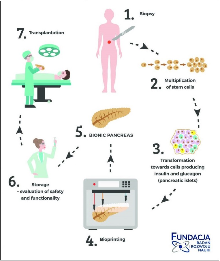 Poland Researchers to 3D Bioprint Bionic Pancreas to Combat Diabetes