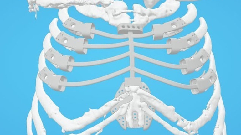 UK patient Becomes Sixth Person in the World Fitted with 3D Printed Rib Cage Implant