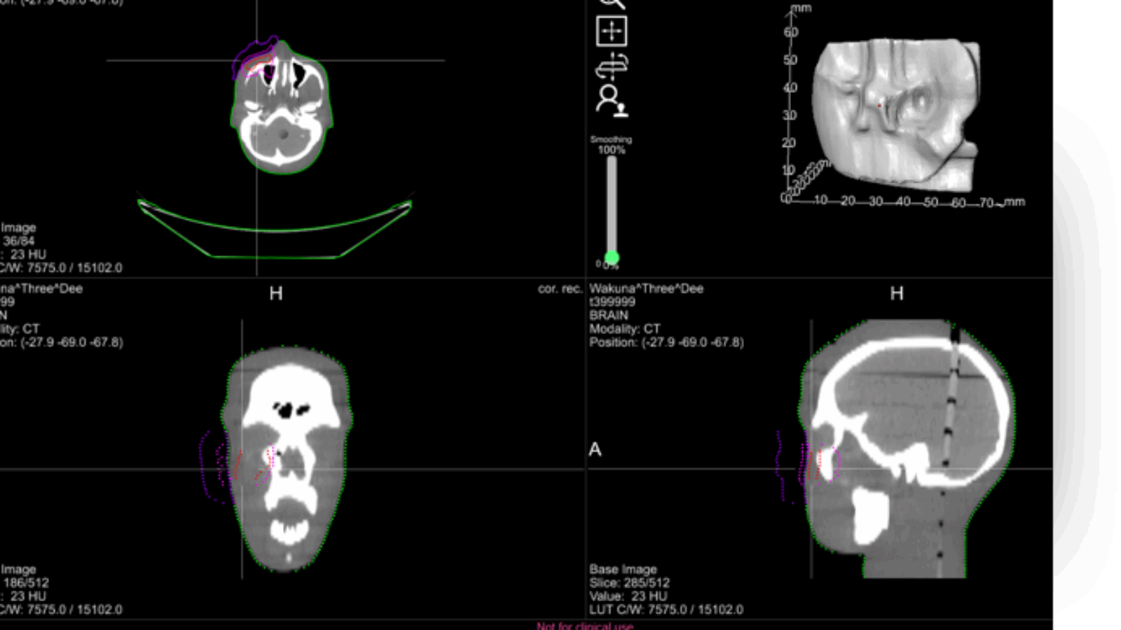 Adaptiiv Medical Technologies Secures $1.8M in Equity Sales to 3D Print Radiotherapy Devices