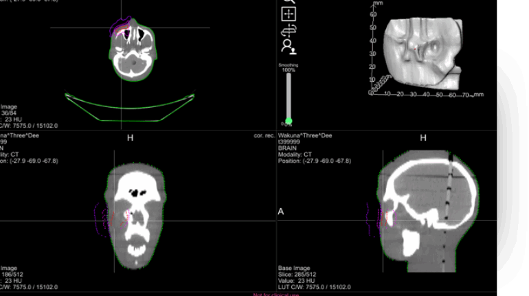 Adaptiiv Medical Technologies Secures $1.8M in Equity Sales to 3D Print Radiotherapy Devices
