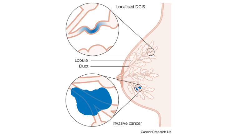 QT Ultrasound Investigates 3D Printing as New Diagnostic Tool for Breast Cancer