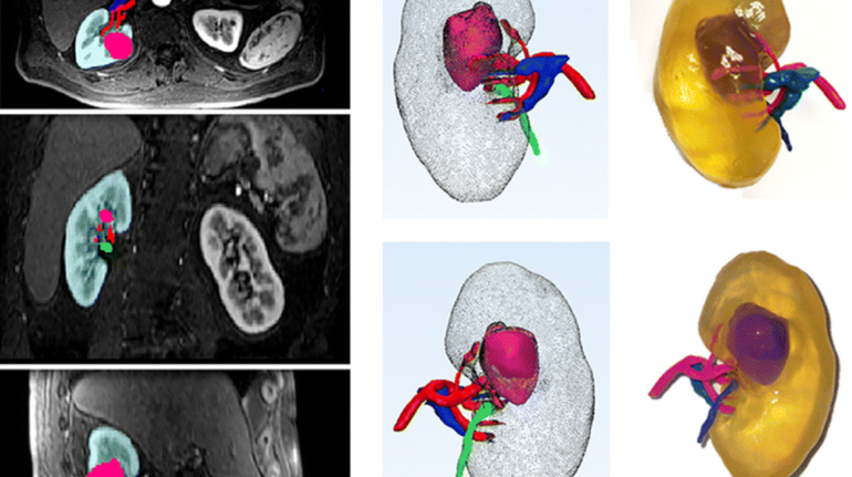 How 3D Printing is Being Used in the Field of Urology