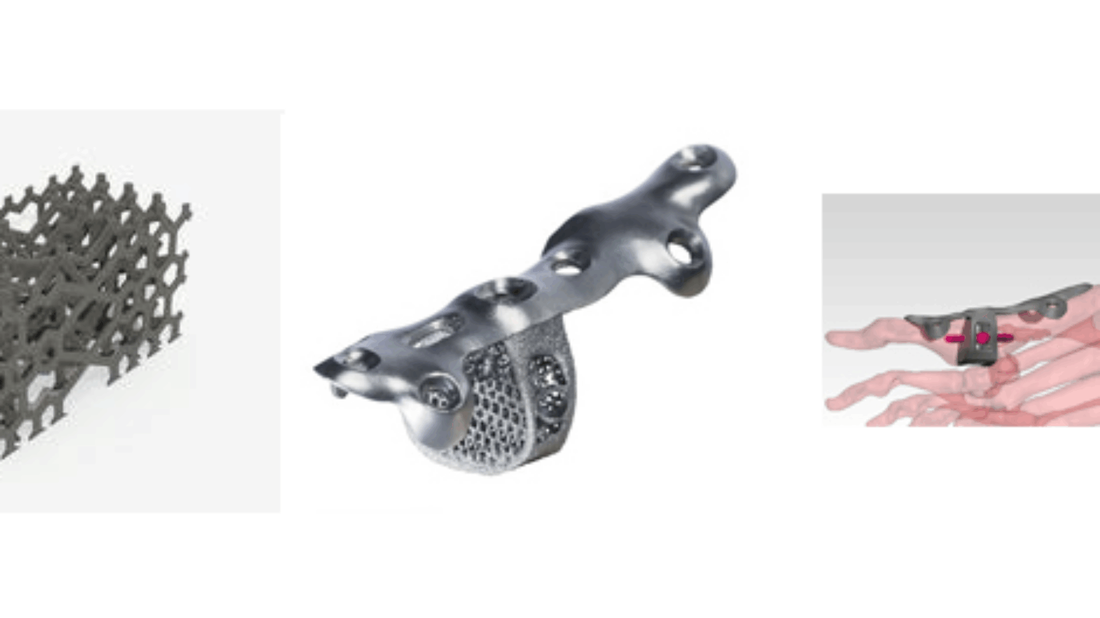 Additive Orthopedics Supplies First 3D Printed Finger Implant in the U.S.