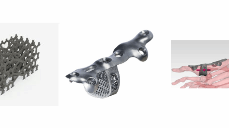 Additive Orthopedics Supplies First 3D Printed Finger Implant in the U.S.