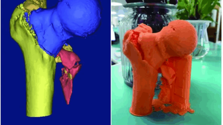 Most Recent Clinical Case Benefited from 3D Printing