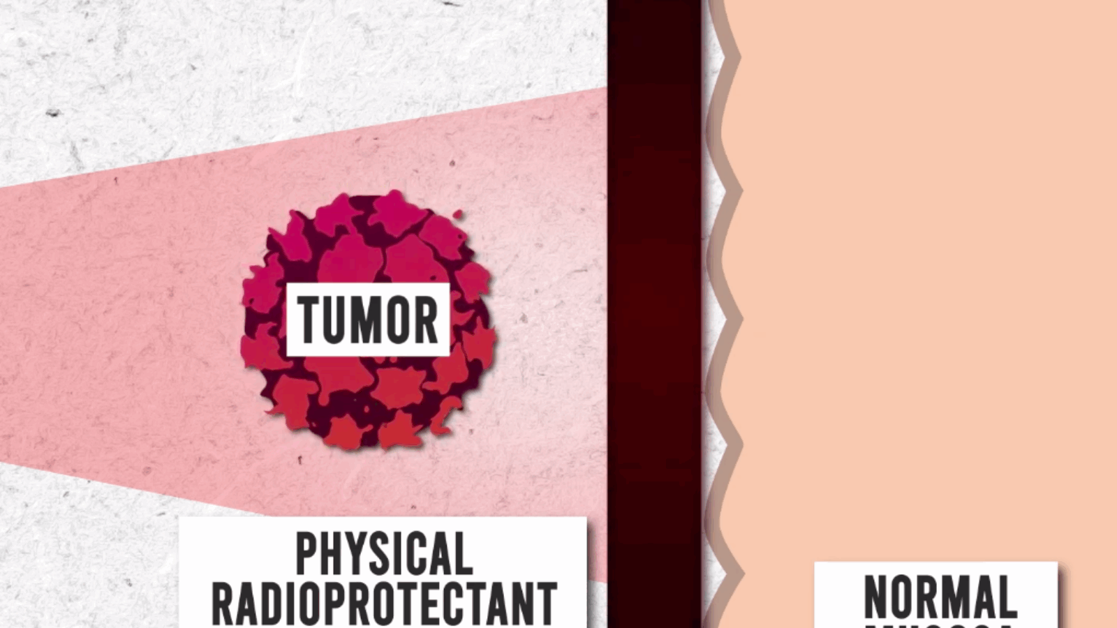Clinicians 3D Print Customized Gastro-Radiation Shielding for Cancer Patients
