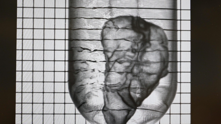 Readily3D Develops 3D Bioprinted Mini Pancreas for Diabetes Drug Testing