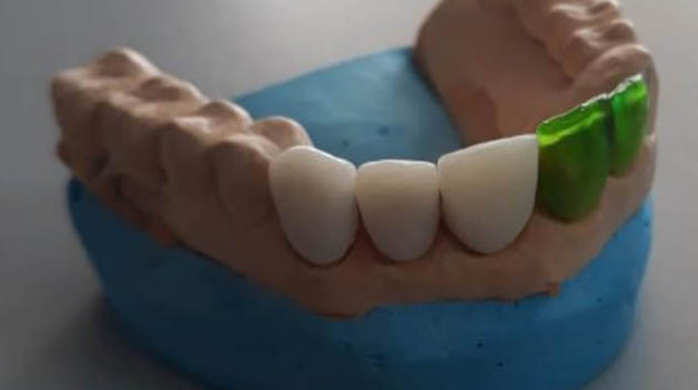Dentafab’s PowerResins Cleared for 3D Printing Crowns and Dentures in EU