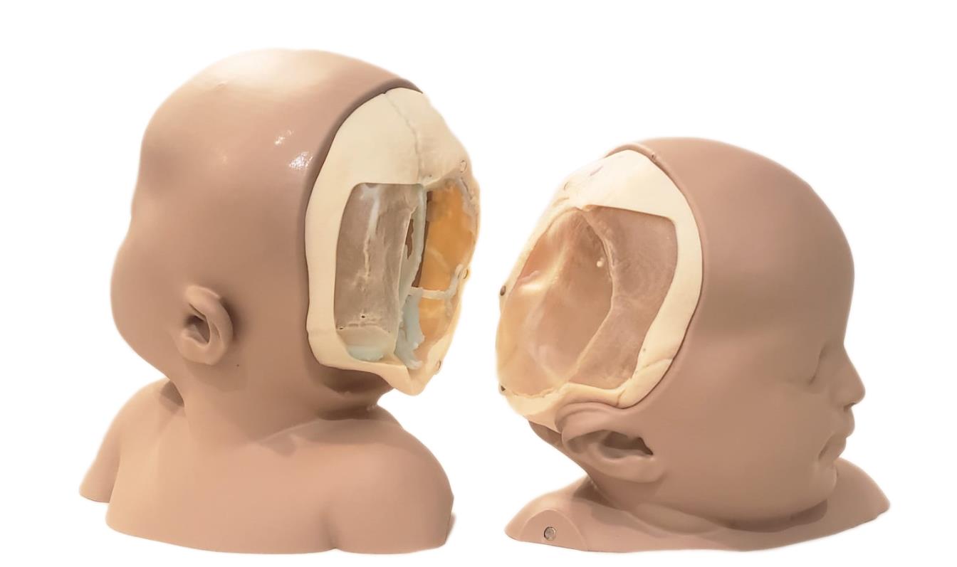 LMI 3D Printed Anatomic Models Help Surgeons Separate Conjoined Twins