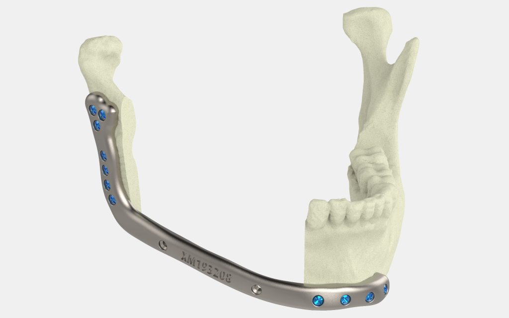 Health Canada Has Approved its First Canadian-made 3D Printed Medical Implant