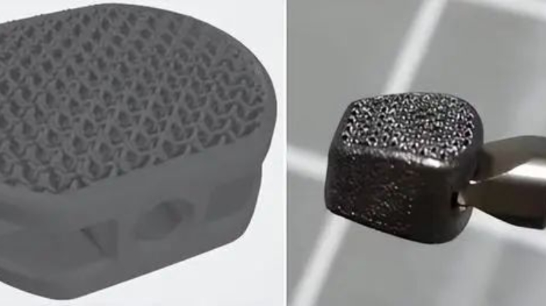 3 Striking Real Cases of Metal 3D Printing in Surgery and Medicine