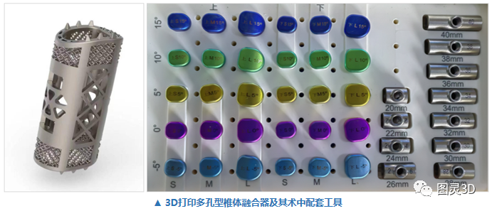 3D printed porous vertebral fusion device and supporting tools. 