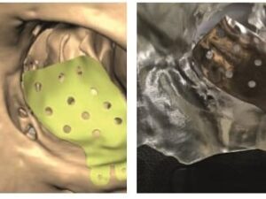 3D Printed SLS Orbital Implant Helps The Patient Restore Her Vision