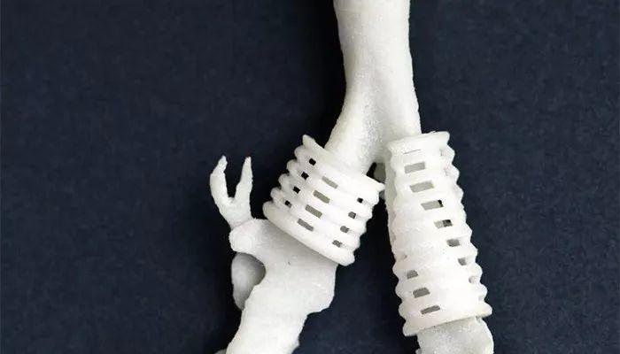 Medical case: 3D printed tracheal stent for complex surgery