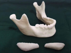 FDM 3D Printed Jaw Model as V-line Surgery Guide