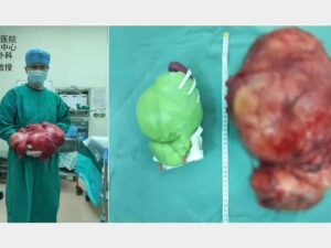PolyJet 3D Printed Tumor Model with Resin for Bowel Cancer Surgery