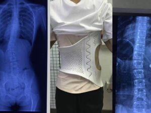 SLS 3D Printed Nylon Back Brace for Scoliosis Patients