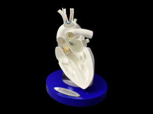 SLA 3D Printed Anatomical Heart Model for PCI Treatment Demonstration